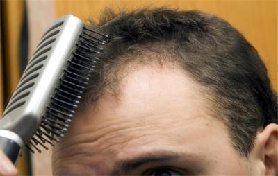 掉头发洗生姜洗发水有用吗，油性头发脱发怎么改善 美发 第3张
